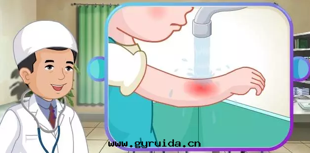 孩子燒傷,防患重(zhòng)于(yú)急救