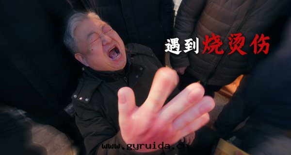 燒燙傷急救手(shǒu)册(cè)：關(guān)鍵时(shí)刻(kè)的(de)救命指南(nán)